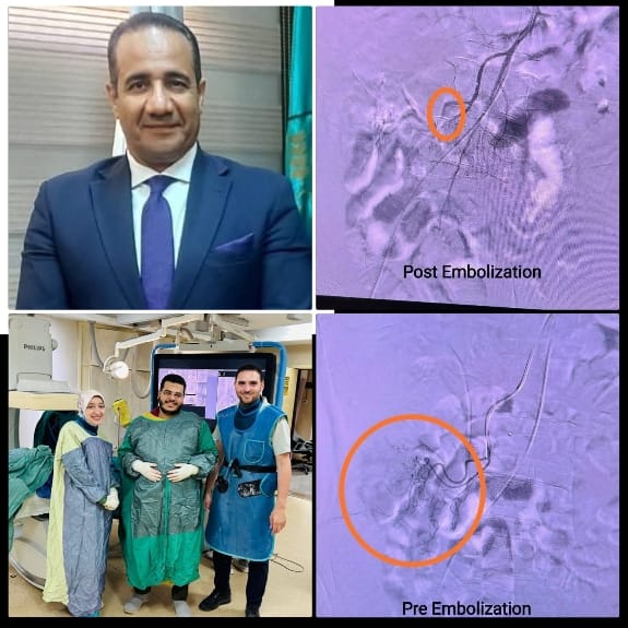 معهد الكبد القومي يسجل إنجازًا طبيًا في عيد الأضحى: قسطرة تداخلية تنقذ حياة مريض من نزيف شرجي حاد