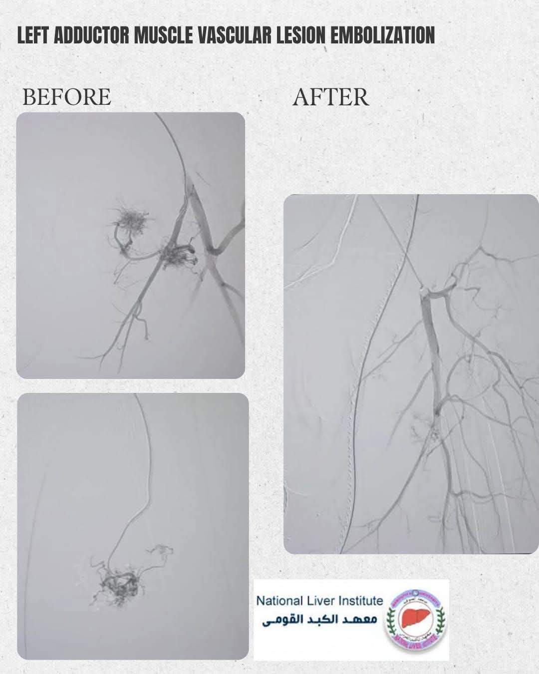 أحد حالات ورشة العمل المنعقدة بقسم الأشعة -وحدة الأشعة التداخلية