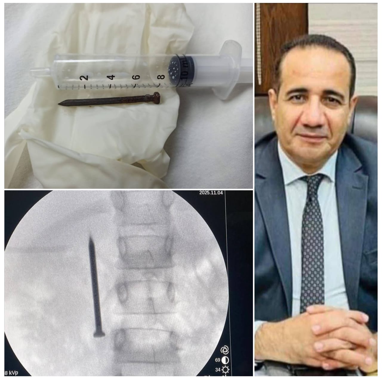 نجاح فريق طبي بمعهد الكبد القومي بالمنوفية في إنقاذ حياة طفله (٧ اعوام) واستخرج مسمارًا بطول ٤ سم من الأمعاء بالمنظار